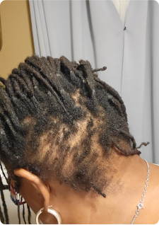 Close-up of a person's head showing hair with visible thinning and braided sections.