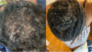 Two images showing before and after treatment of scalp and hair condition.