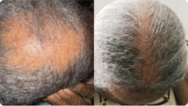 Two side-by-side images showing hair growth improvement on a person's scalp.