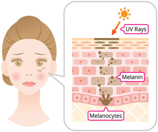 Illustration of skin showing UV rays affecting melanin production.