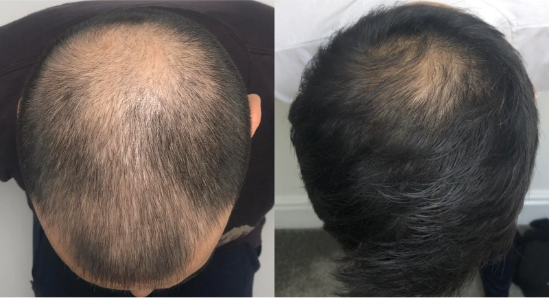 Before and after image showing hair growth on the crown of the head.