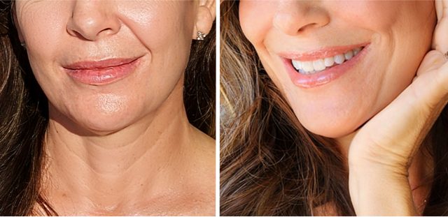 Close-up side-by-side photo showing different stages of a woman's smile.