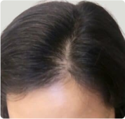 A person's scalp with dark hair showing a center hair part.